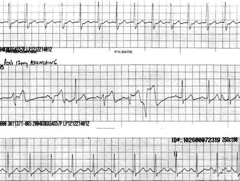 Preexcitation Syndromes Litfl Ecg Library Diagnosis