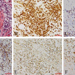 a. HE staining reveals plasma cells and Russell bodies.... | Download ...