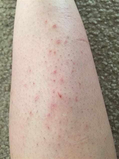 Skin Concern How Should I Get Rid Of These Picking Scars Rskincareaddiction