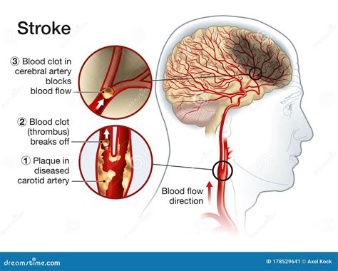 Blood Clot Brain Royalty-Free Cartoon | CartoonDealer.com #99725099