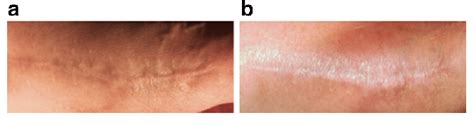 A Hypertrophic Surgical Scar Following Reconstructive Surgery Of The