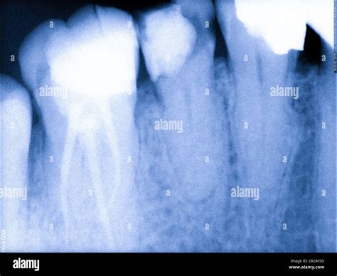 Periodontal Diagnostics Hi Res Stock Photography And Images Alamy