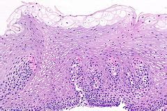 Glycogenic acanthosis of the esophagus - Libre Pathology