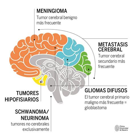 Los Tumores Cerebrales Tipos Y Sintomas Principales Howtodoes