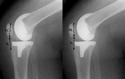 The Radiological Assessment Of Total And Unicompartmental Knee