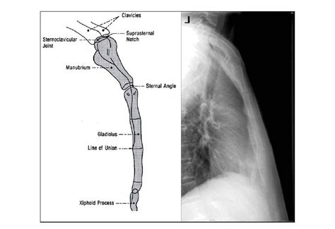 Radiology Anatomy Images : Sternum X-RAY anatomy