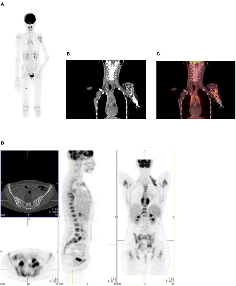 Frontiers Normal Variants And Pitfalls Of F Fdg Pet Ct Imaging In