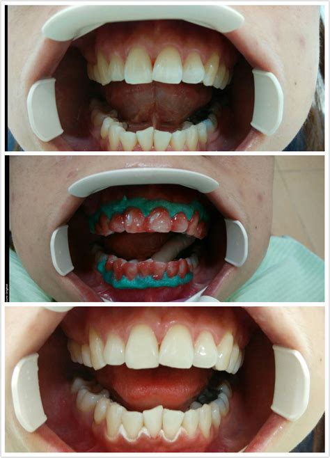 Tooth bleaching | Save A Smile Dental Clinic