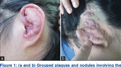 Figure From Angiolymphoid Hyperplasia With Eosinophilia Treated With