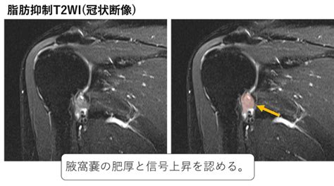 凍結肩肩関節周囲炎のmri画像所見のポイント！