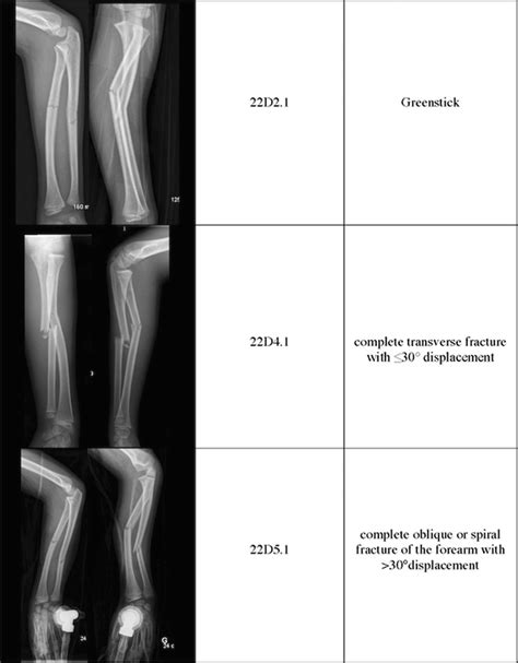 Fracture Of The Forearm According To The Pediatric Comprehensive