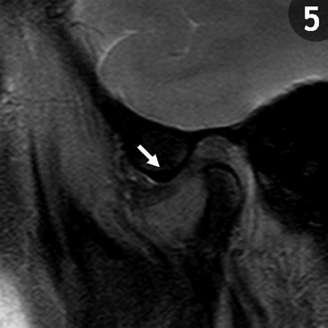 Anterior Disc Displacement Without Reduction Left Tmj Sagittal Plane Download Scientific