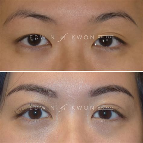 Asian Upper Blepharoplasty Before And Afters Edwin Kwon Md Facs