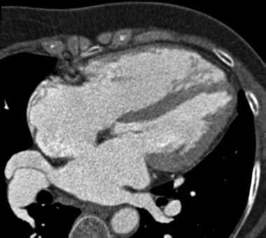 Imaging In Atrial Septal Defects Overview Radiography Computed