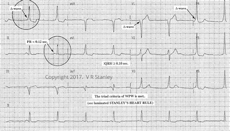 Wolff Parkinson White Syndrome And The Short Pr Interval On Ecg