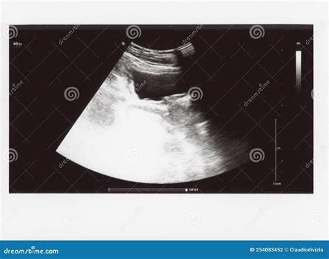 Full Abdomen Ultrasound Sonogram Stock Photo Image Of Sonografie