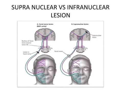 Facial Nerve Pathophysiology Electrodiagnostic And Imaging Ppt