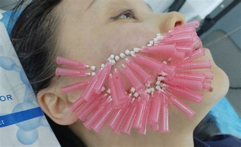 Your Ultimate Guide To Collagen Threads For Wrinkles Diaminyaesthetics
