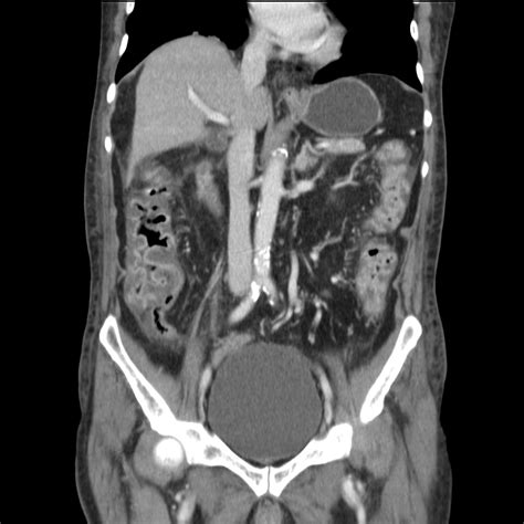 Pseudomembranous Colitis Image Radiopaedia Org