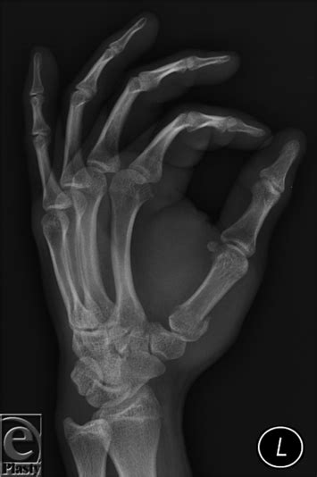 Update On The Treatment Of Metacarpal Fractures