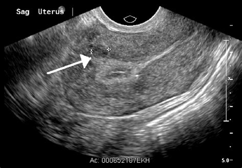 Intramural Fibroid Ultrasound