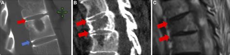 Vertebral Compression Fracture After Spine Stereotactic Body