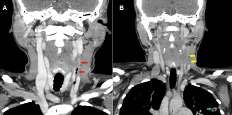 Soft Tissue Neck Ct Scan