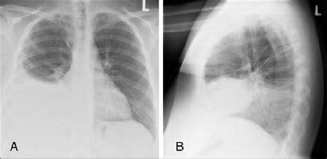 Posteroanterior A And Lateral B Chest Radiographs Showing A Right