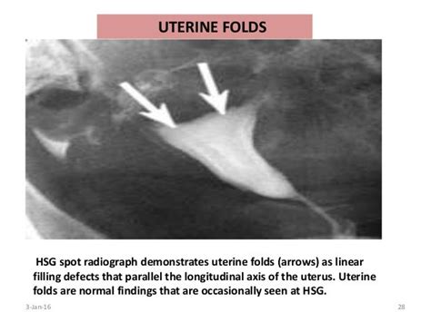 Hysterosalpingography