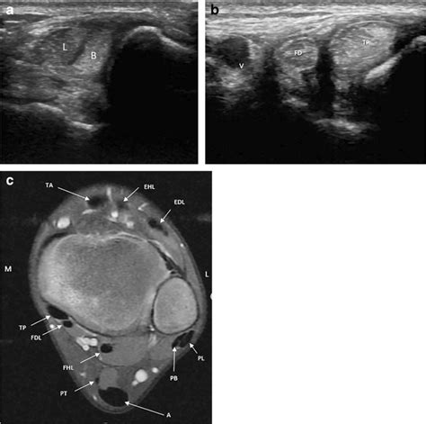 Normal Ankle Tendons A B Us In A 17 Year Old Girl With Download