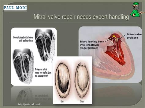 mitral valve repair | PPT