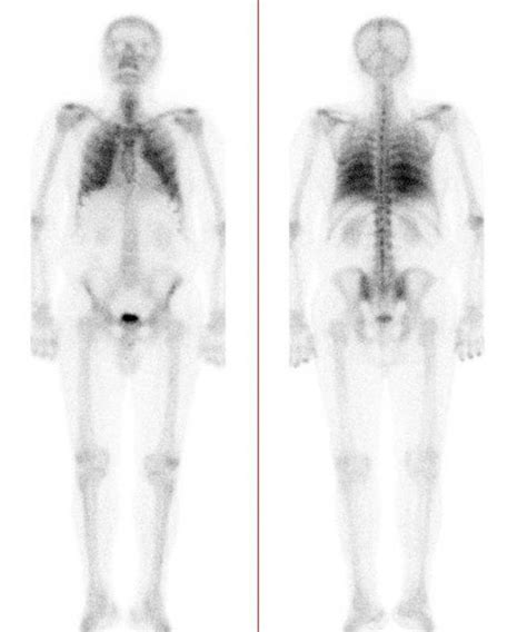 Bone Scintigraphy Showing Intense Bilateral Uptake Of Technetium 99m