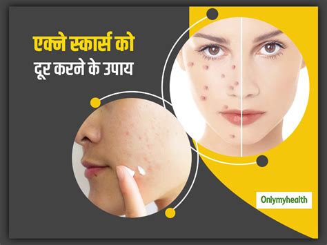 Try These 5 Natural Remedies To Get Rid Of Acne Scars In Hindi एक्‍ने