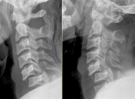 Cervical Spine Subluxation