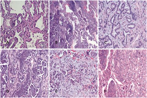 Histological Subtypes Of Lung Adenocarcinoma A Adenocarcinoma In Download Scientific Diagram