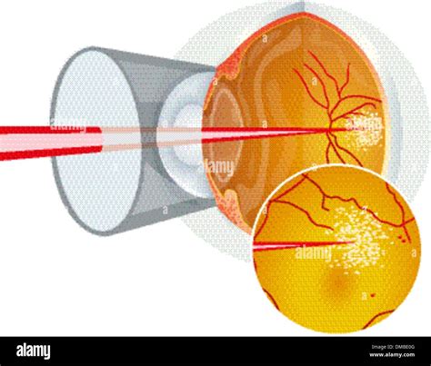 Chirurgie Oculaire Au Laser Banque De Photographies Et Dimages Haute