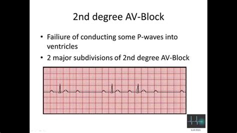 ECG cardiac arrhythmias - YouTube