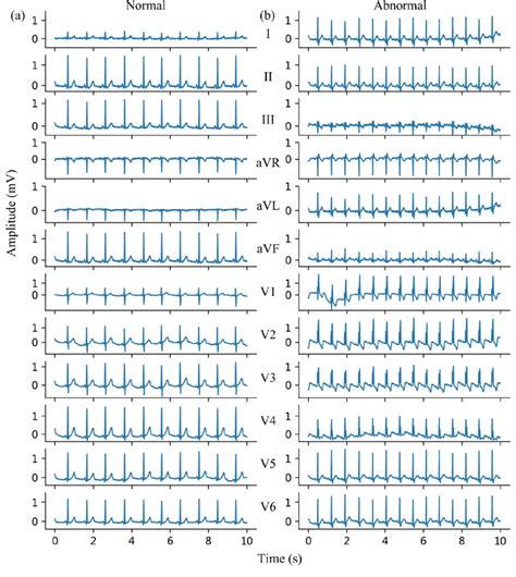 A Normal Ecg Sample And B Abnormal Ecg Sample In Preliminary