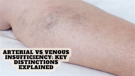 Arterial Vs Venous Insufficiency Key Distinctions Explained U Elitevs