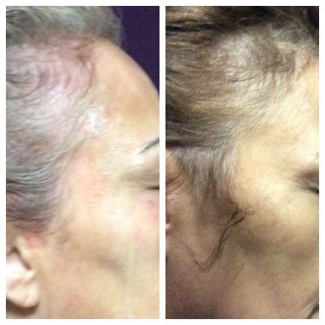 Prp Hair Restoration Before And After Pictures Halo