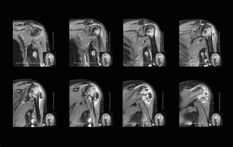 Arthrogram Joint Imaging • Touchstone Medical Imaging