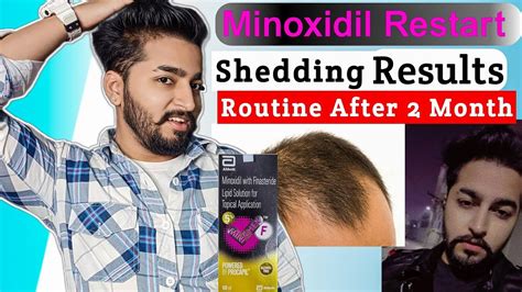 Minoxidil Restart After Month Condition Youtube