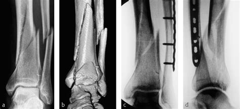 Tibia And Fibula Distal—introduction Musculoskeletal Key