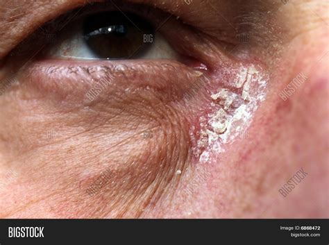 Psoriasis - Psoriasis Corner My Eye Image & Photo | Bigstock