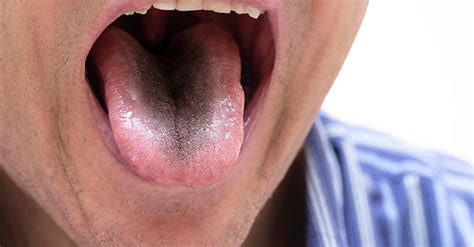 BLACK HAIRY TONGUE CAUSES, SYMPTOMS, AND TREATMENTS - Bitvae Electric ...