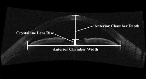 Anterior Segment Variations With Age And Accommodation Demonstrated By