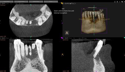 CASE FILE: Internal resorption and bone loss – CDI – Canadian Digital ...