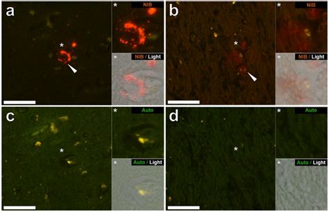 Ijerph Free Full Text Aluminium In Brain Tissue In Multiple Sclerosis