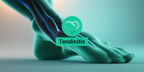 Tendinitis Causes Symptoms And Treatment Options Yesil Health