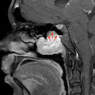 Case Sagittal Gadolinium Enhanced T Fs Mri Image Demonstrating Avid